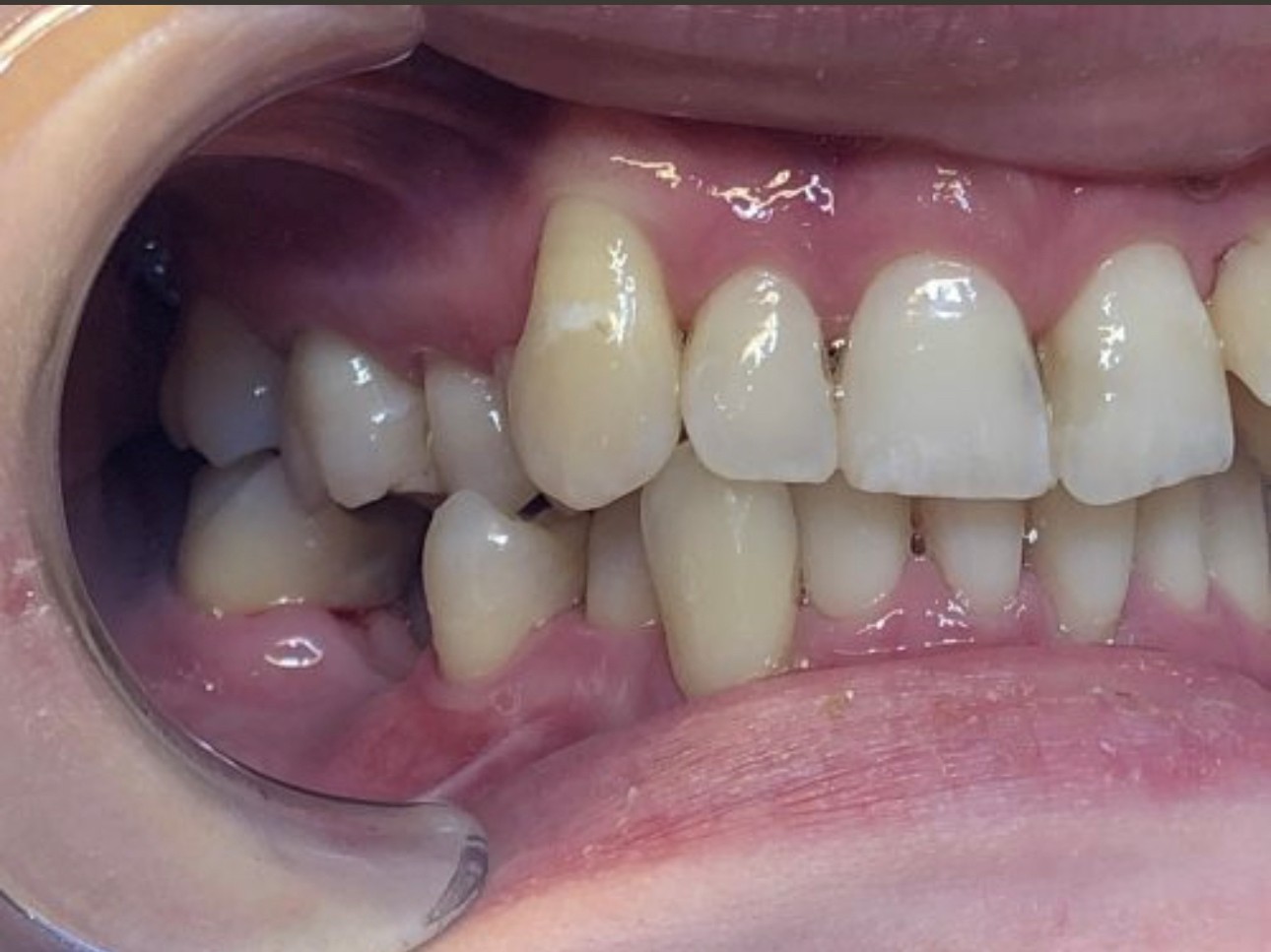 Invisalign implantti