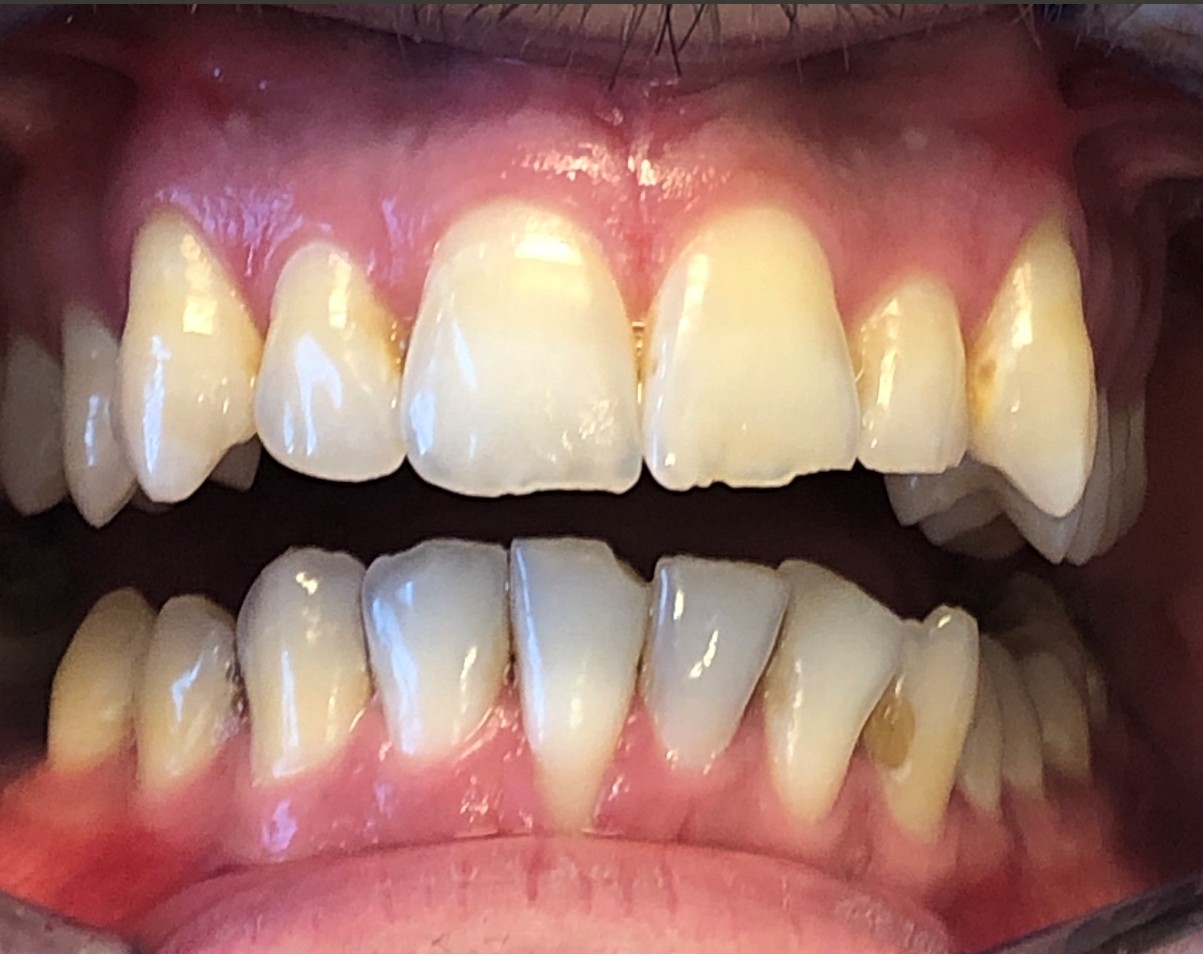 Invisalign ja muovimuotoilua