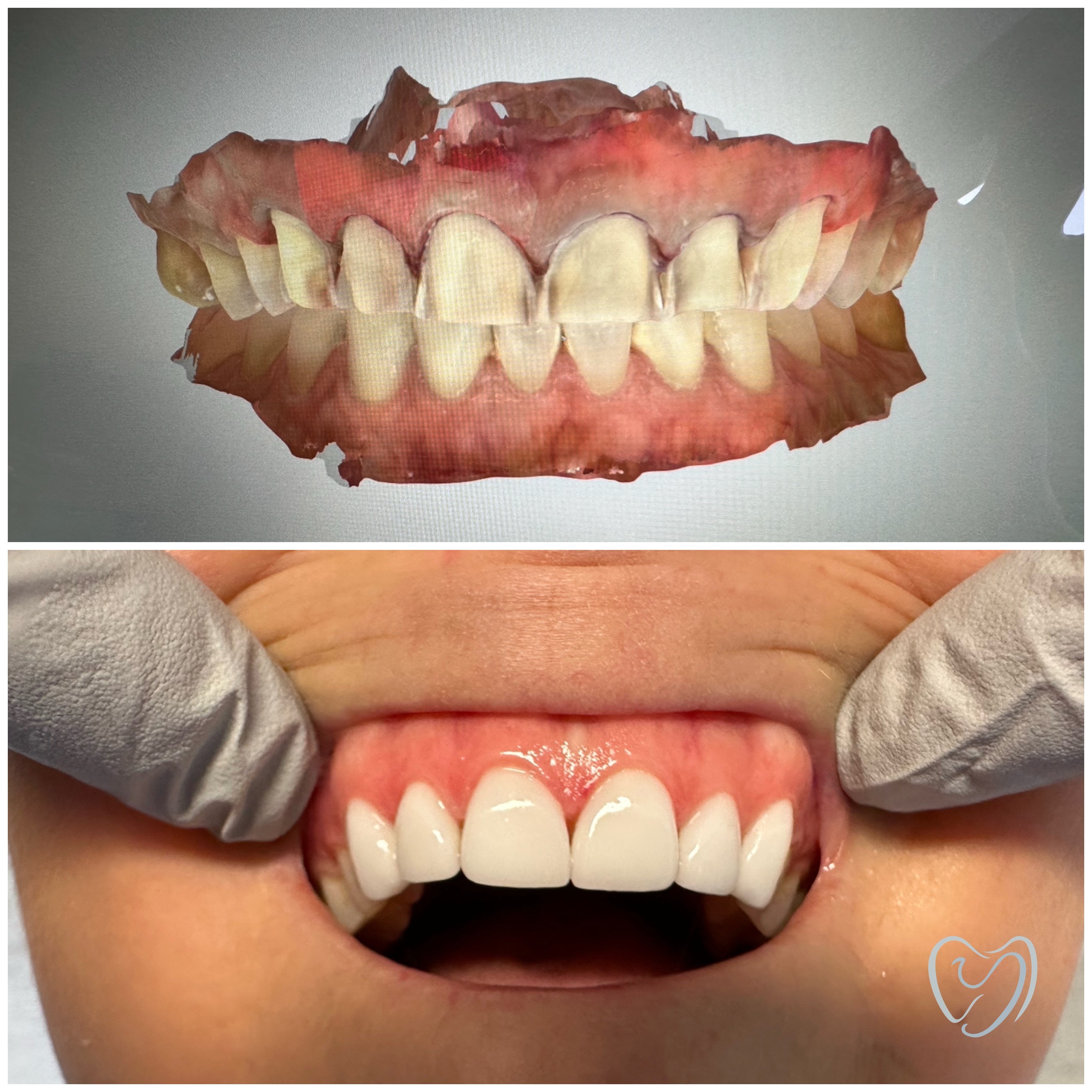 Invisalign10