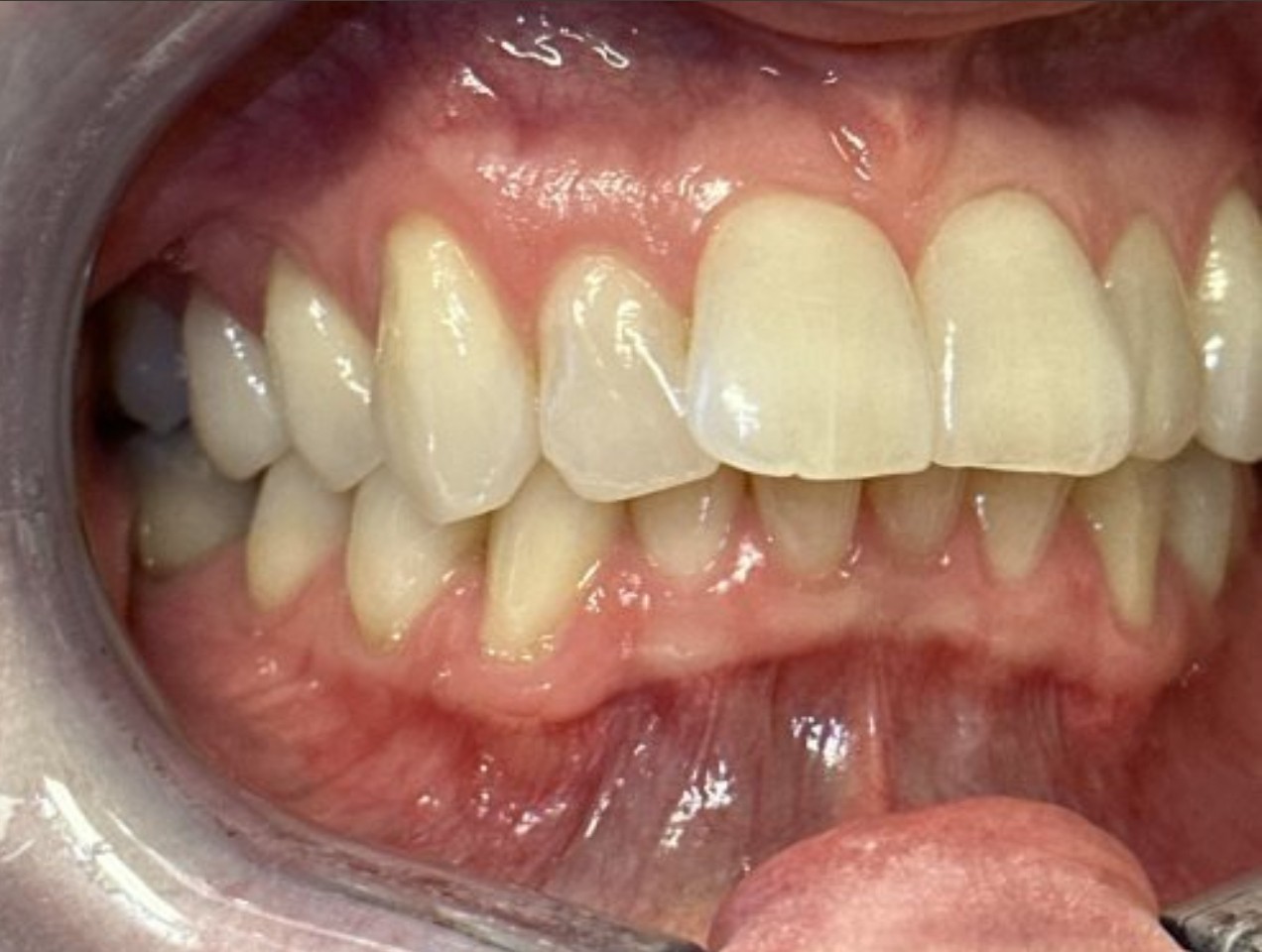 Invisalign11