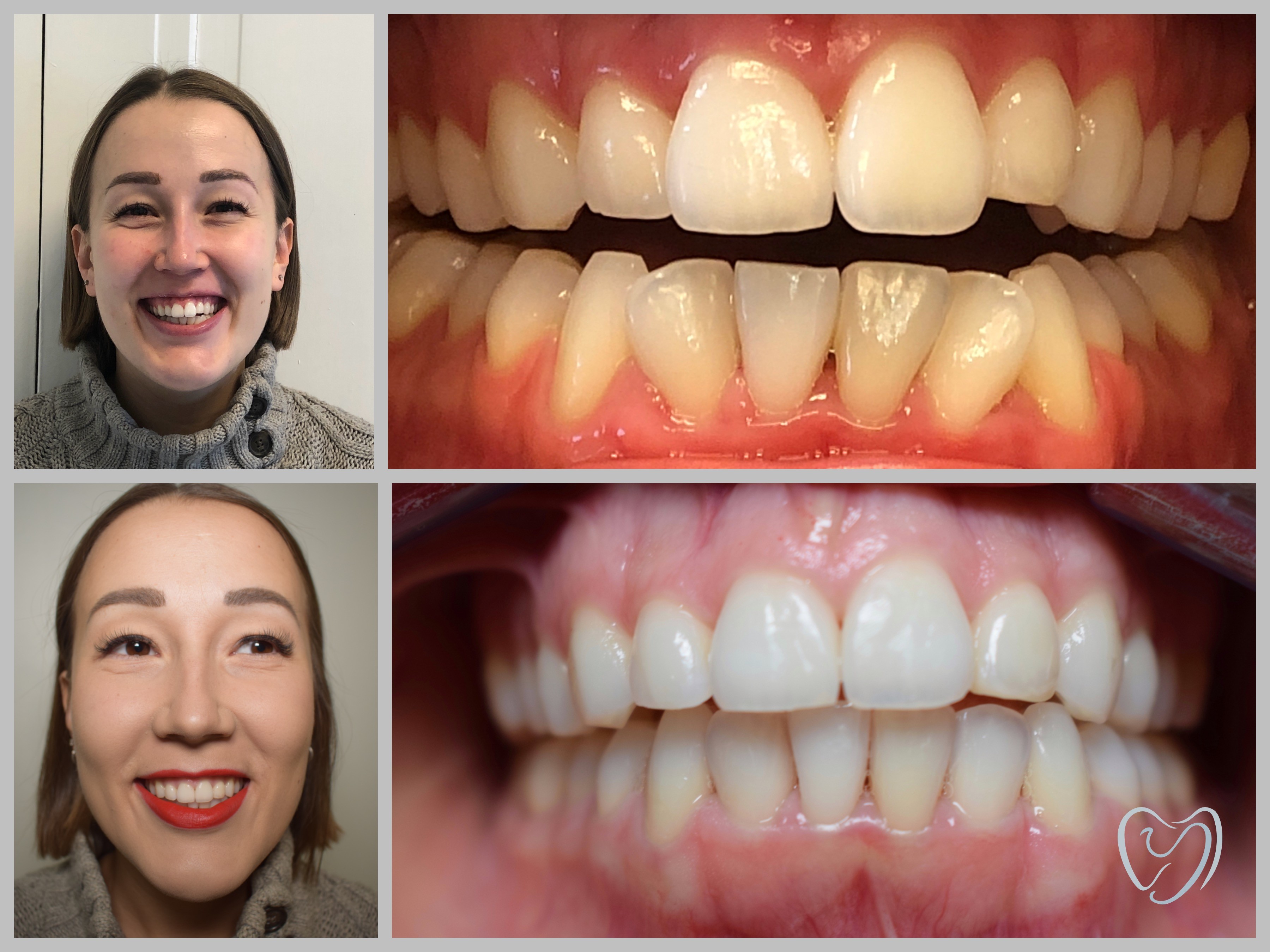 Invisalign2