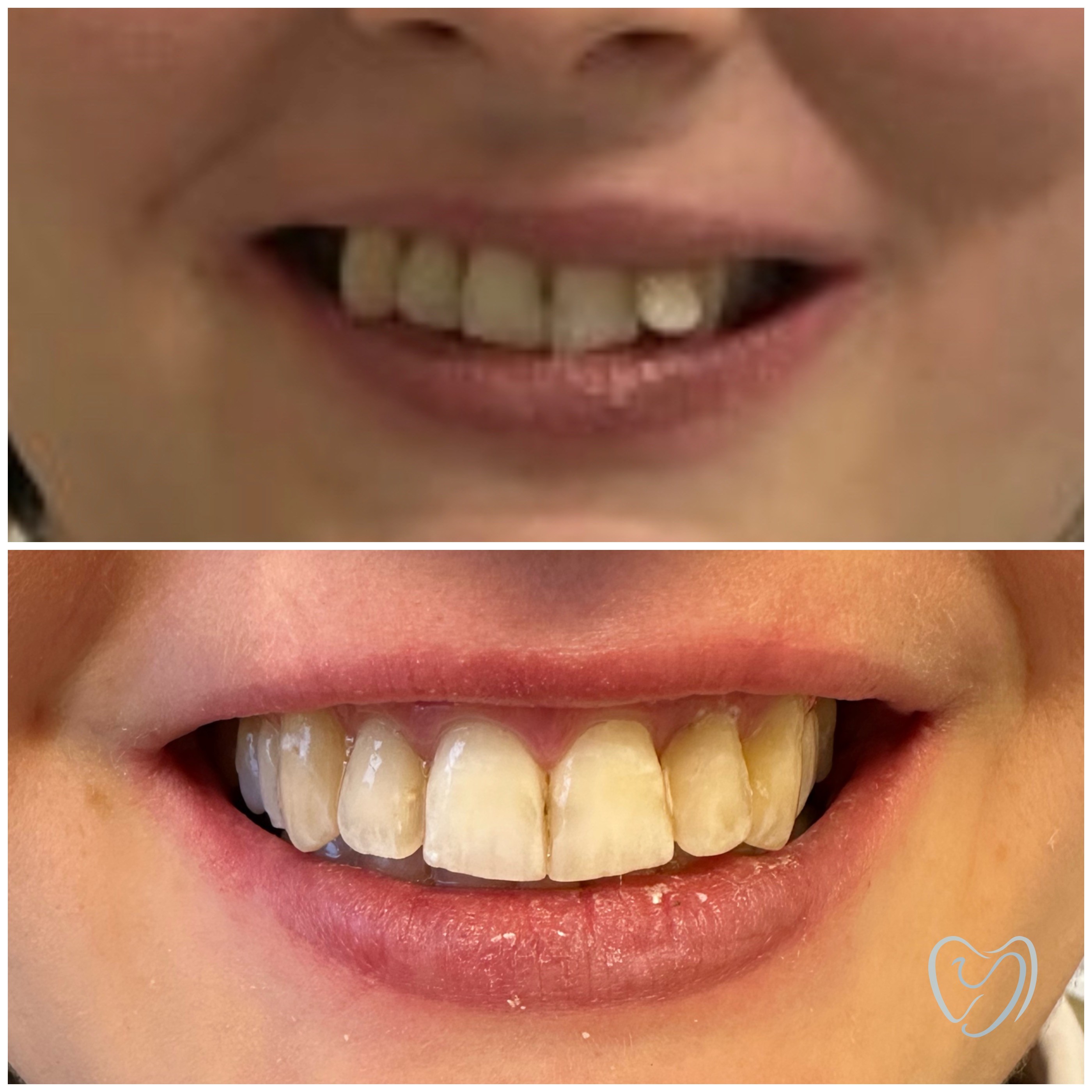 Invisalign5