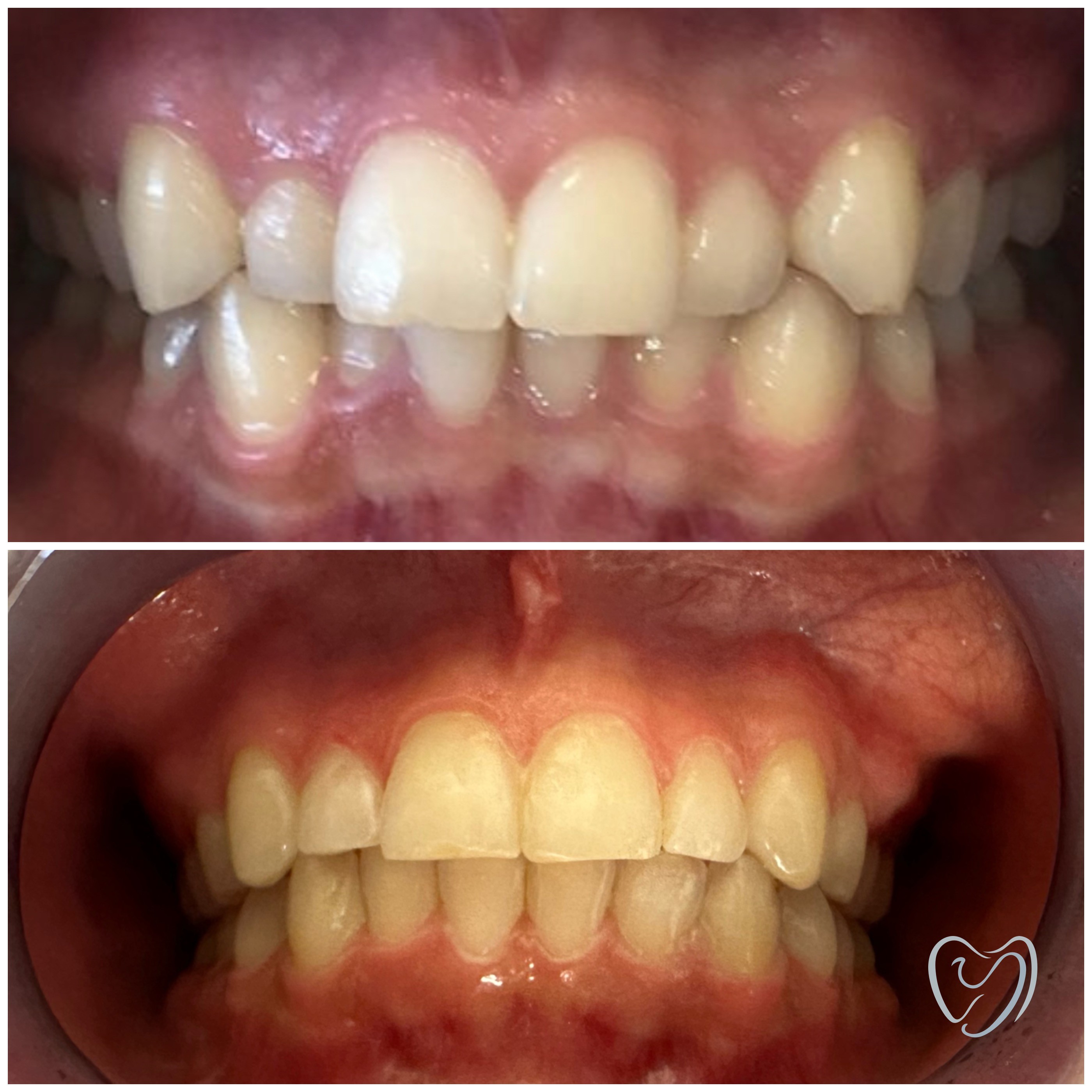 Invisalign7