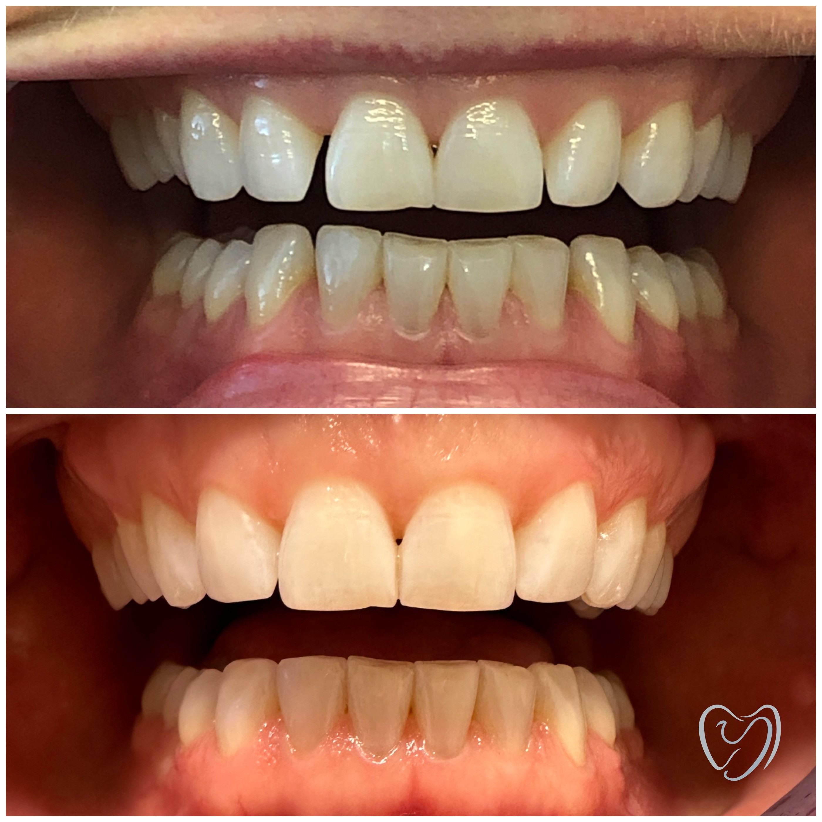 Invisalign8
