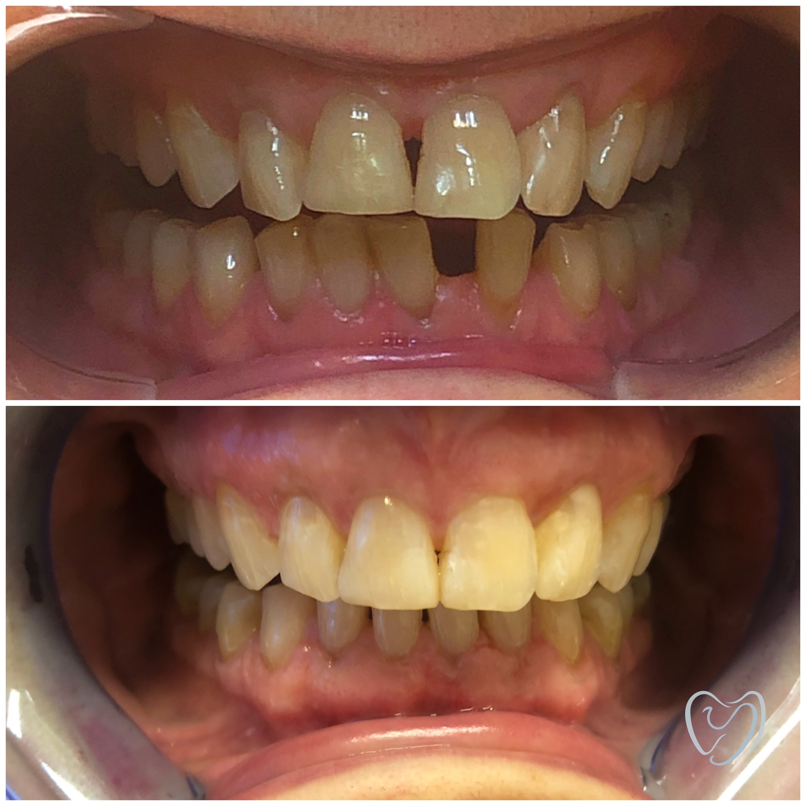 Invisalign9