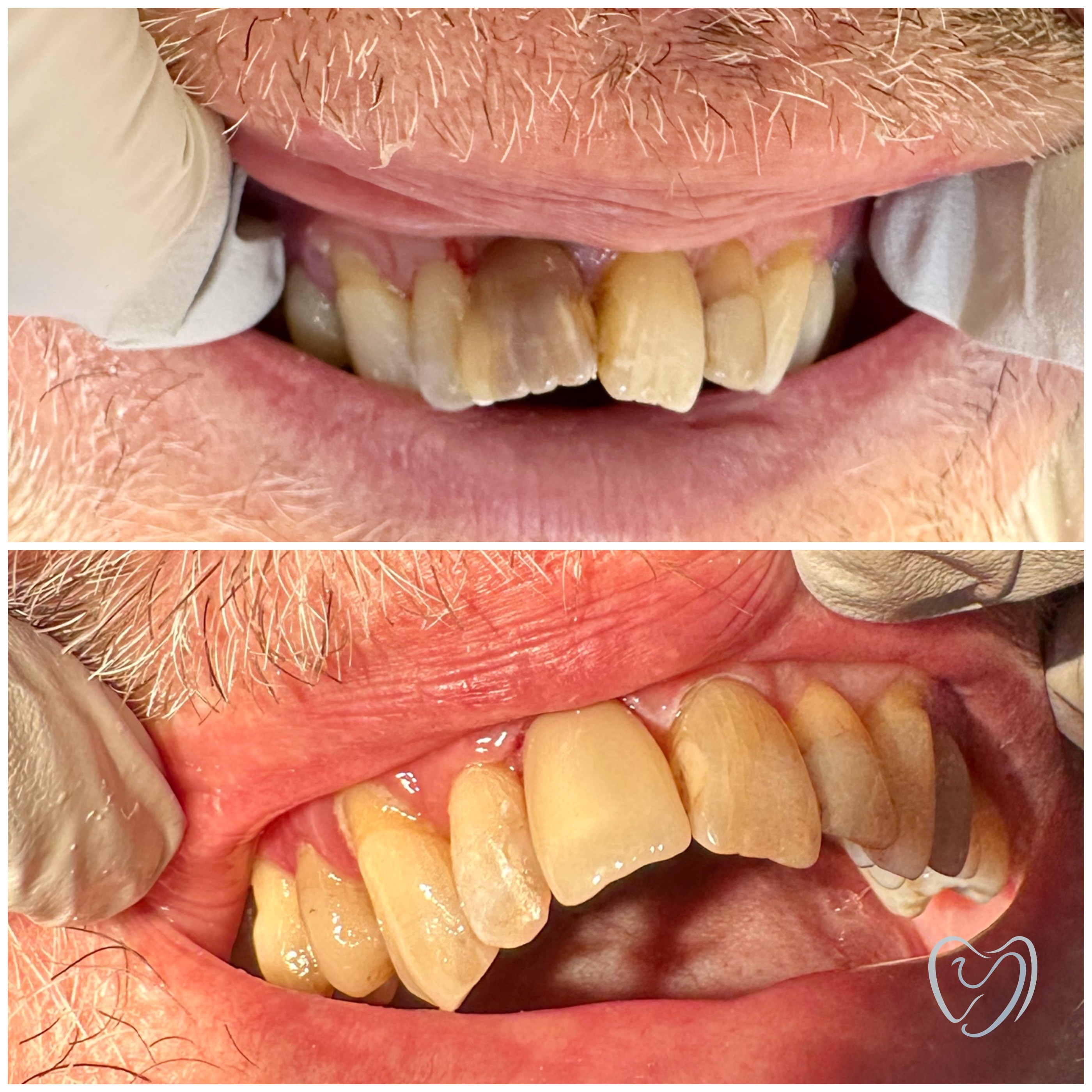 Keraaminen druunu d11