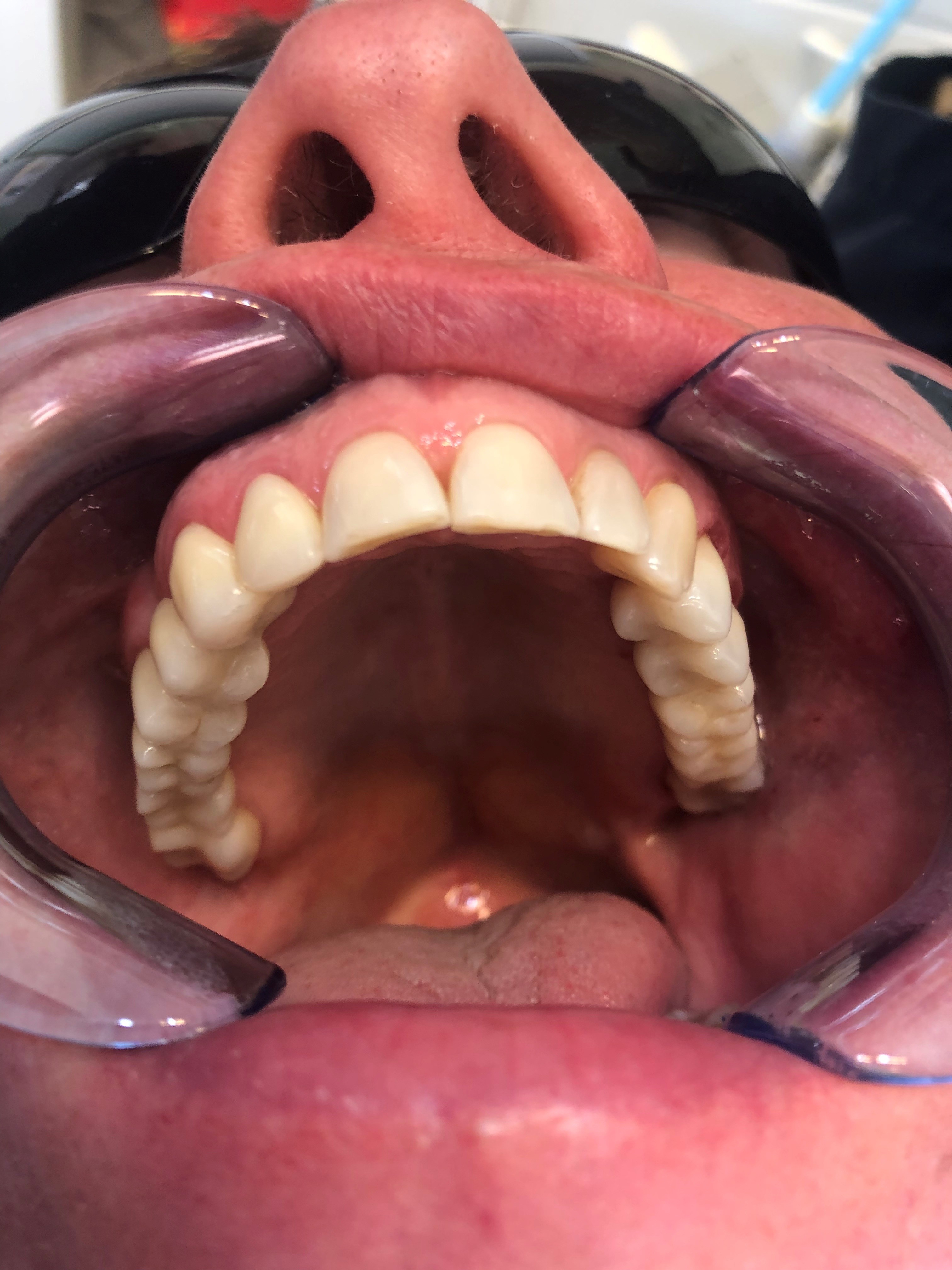 Keraamiset sillat yläleuassa molemminpuolin