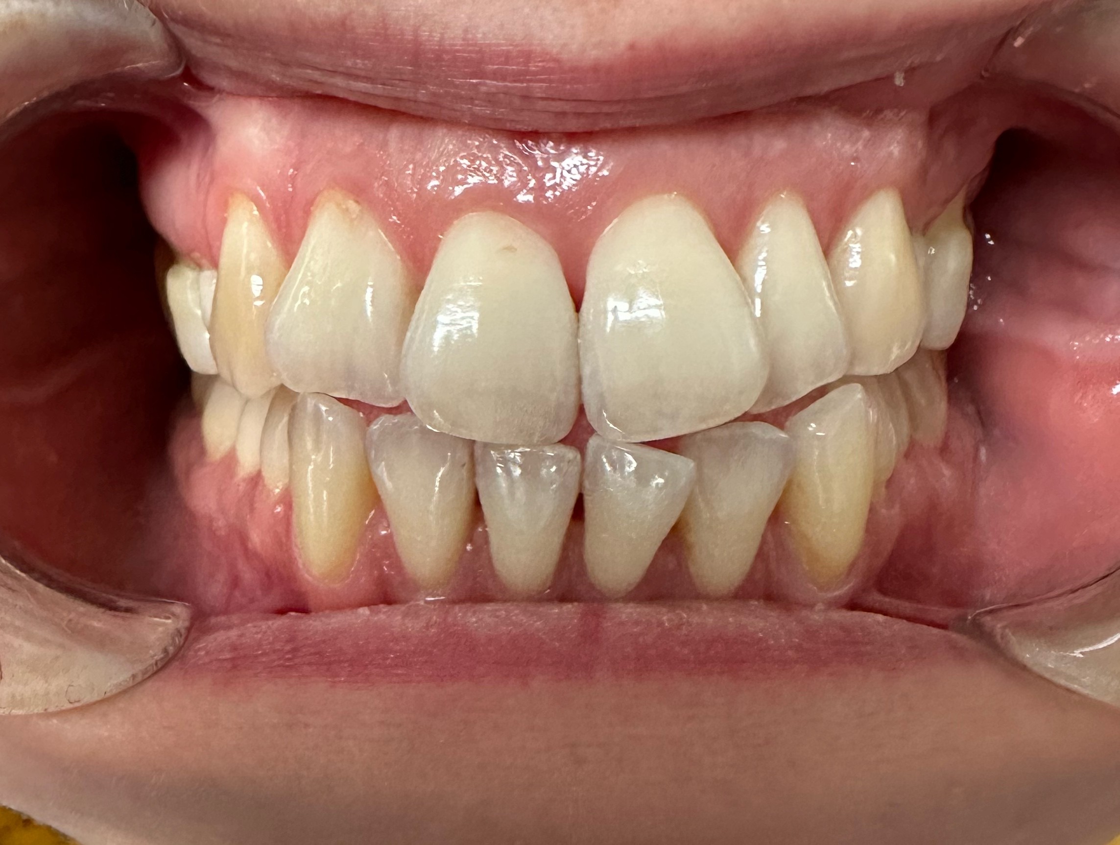 Kruunuja yläetualueella