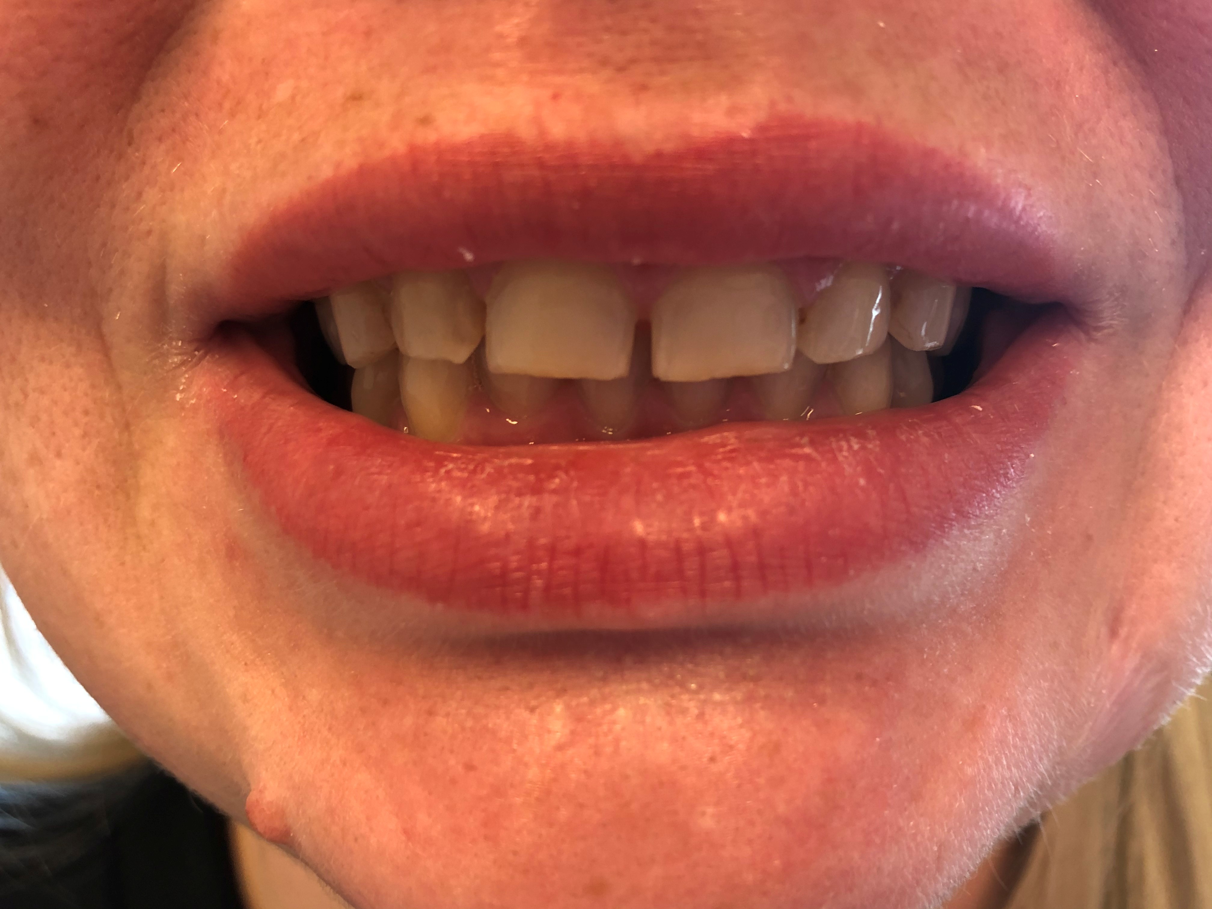 Keraamiset laminaatit