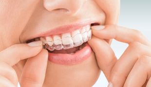 Reikiintyneet hampaat