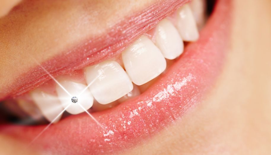 Hammaskorun kiinnitys