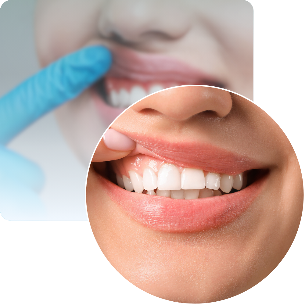 Hammasimplanttileikkausten porasetti