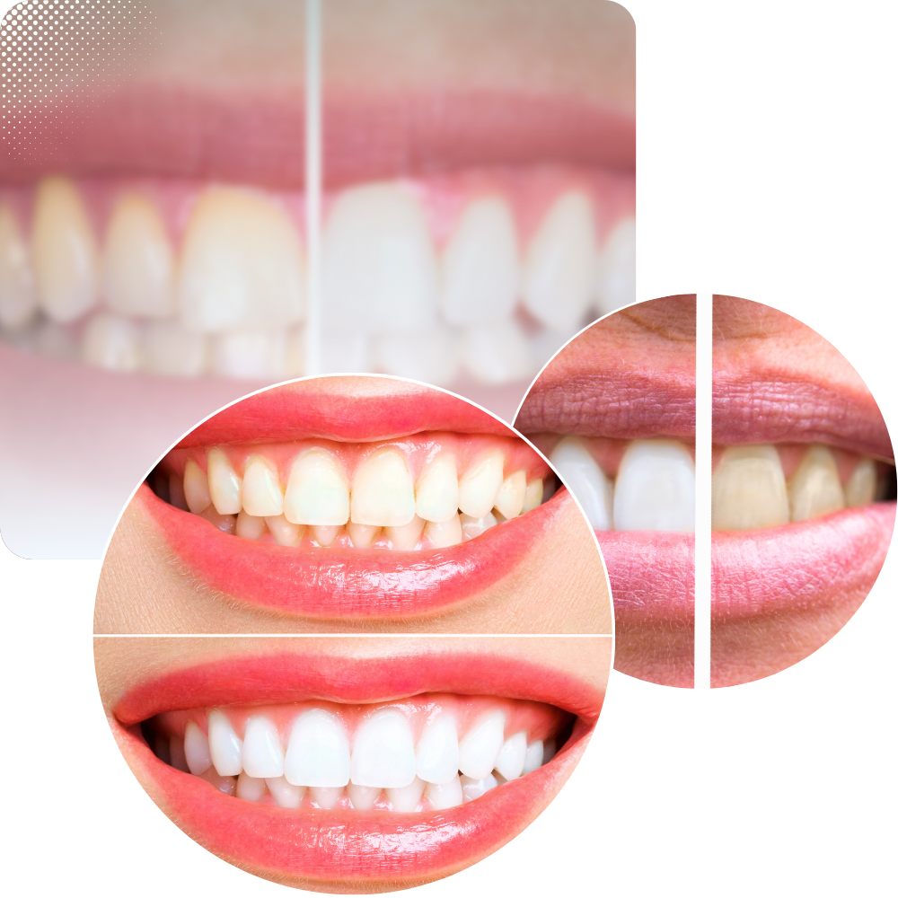 Hampaiden jauhepuhdistus