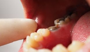 Reikiintyneet hampaat